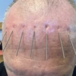 Scalp Acupuncture Skalp Akupunktur