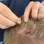 WHO Scalp Acupuncture