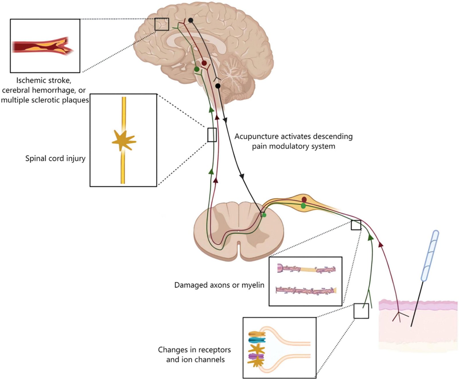 acupuncture for neuropathic pain